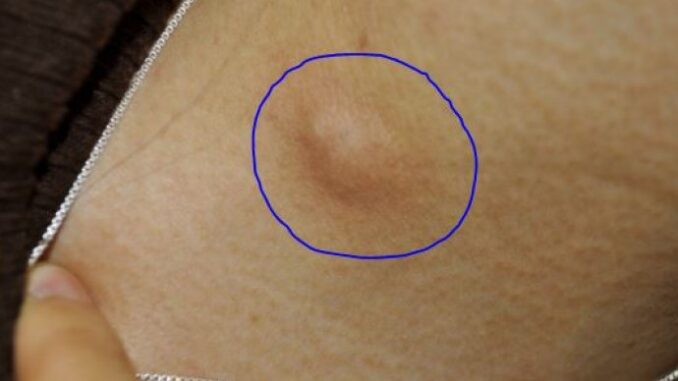 5d14afd2-512c-485b-acbd-0ada0a0a0a64-lump-under-armpit-690x480